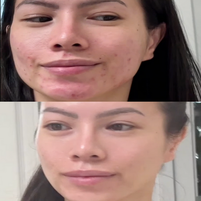 LED Light Therapy Mask Skin Care